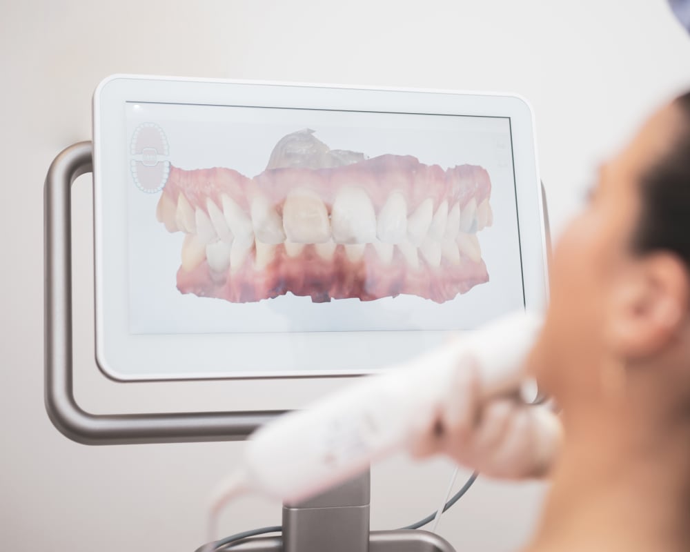 Invisalign Step 2, Longueuil Dentist